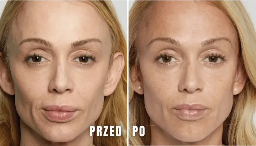 Ile kwasu hialuronowego dziennie? Sprawdź, aby uniknąć błędów