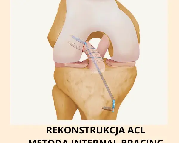 Rekonstrukcja ACL prywatnie czy na NFZ – co wybrać, by uniknąć błędów i kosztów?