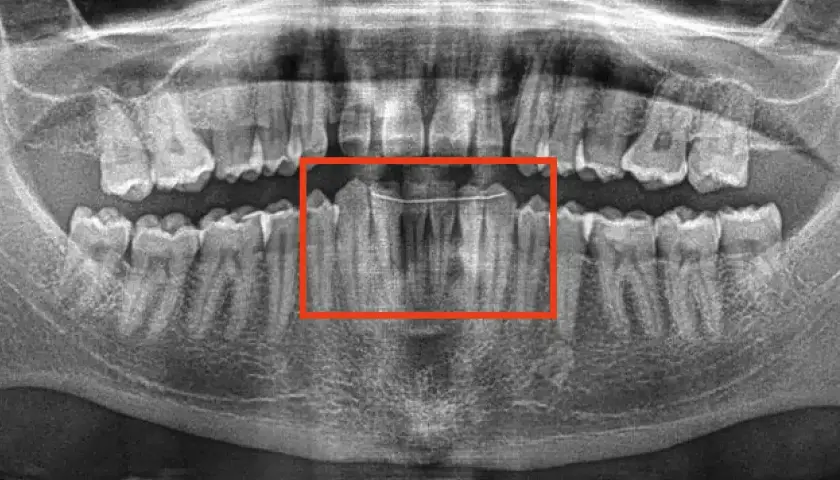 Radiografia panoramica dei denti con un filo metallico che stabilizza i denti anteriori. Un dente che si muove si può salvare con cure adeguate.