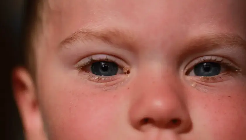 Ojos de niño con secreción, sugiriendo la necesidad de gotas para conjuntivitis en niños.