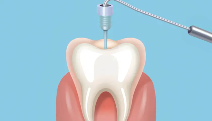 Ilustracja przedstawia narzędzie dentystyczne w zębie, symbolizujące potencjalne objawy stanu zapalnego po leczeniu kanałowym.