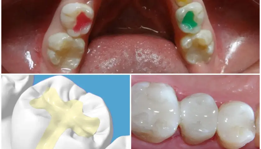 Sigillatura molari bambini: pro e contro. Denti con sigillante colorato e modello 3D di applicazione.