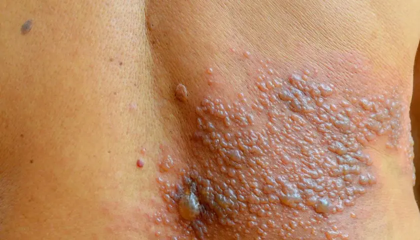 Eruzione cutanea con vescicole, simile al fuoco di Sant'Antonio, su un fianco. Non è comune nei bambini, ma può verificarsi.