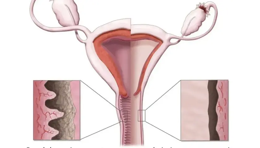 Ilustracja pokazuje zmiany w pochwie podczas menopauzy, prowadzące do suchości pochwy.