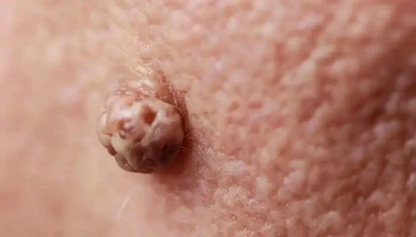Gros plan d'un acrochordon douloureux sur la peau, texture rugueuse et irrégulière.