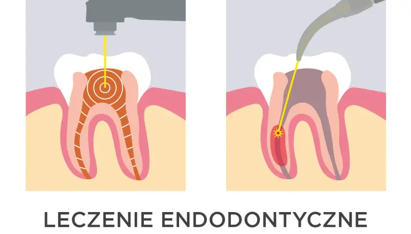 Ilustracja pokazuje laserowe leczenie zębów. Dwa schematy przedstawiają zastosowanie lasera w leczeniu kanałowym, podkreślając jego precyzję i skuteczność.