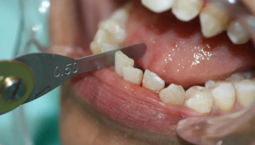 Herramienta dental mide 0.50mm para limar dientes, parte del proceso de tratamiento con Invisalign.