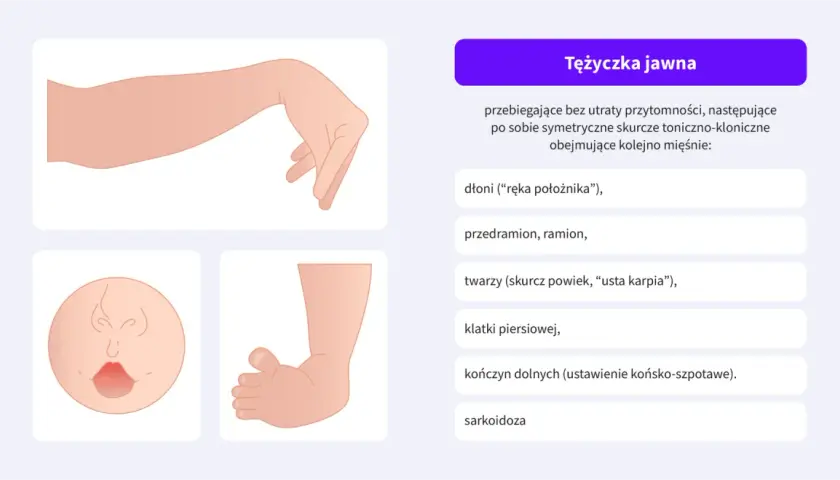 Tężyczka nerwicowa objawy: dłoń jak u położnika, skurcz twarzy, "usta karpia", drętwienie kończyn.