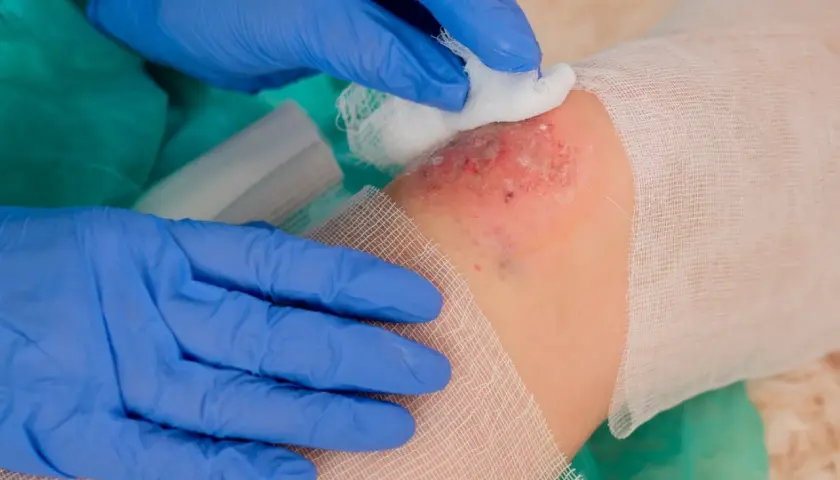 Lekarz w niebieskich rękawiczkach delikatnie oczyszcza ranę, na której widoczny jest biofilm.