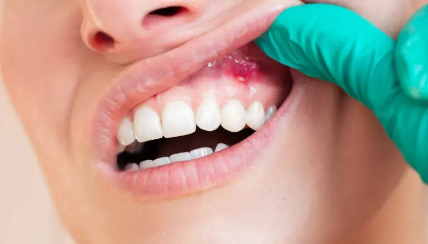 Gingivitis, zapalenie dziąseł. Periodontolog czym się zajmuje? Leczeniem chorób przyzębia, w tym zapalenia dziąseł.