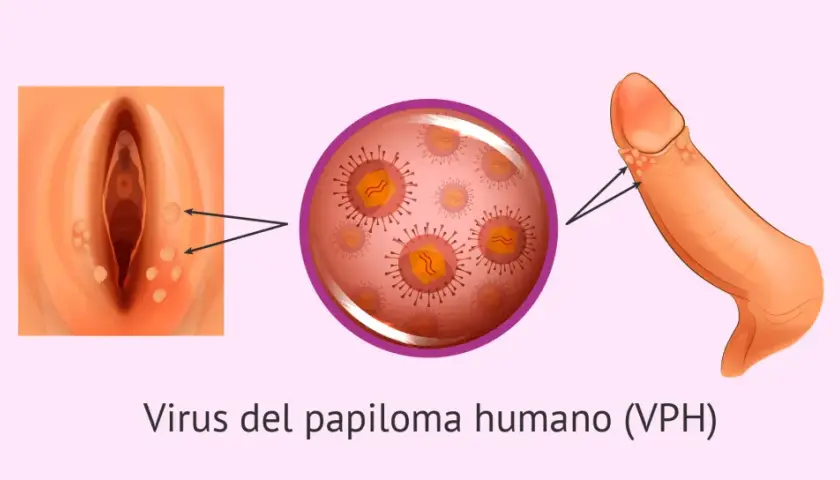 Síntomas del papiloma humano en mujeres: lo que debes saber para actuar