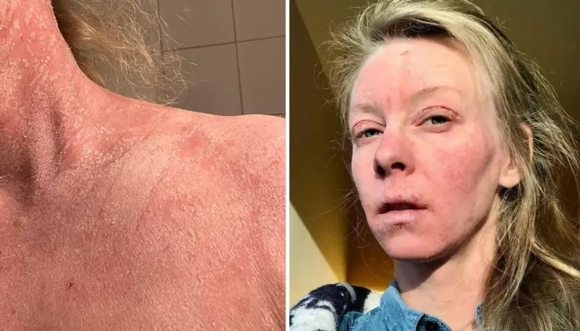 Bilden visar en person med svår hudirritation och fjällning på halsen och ansiktet, möjligen som en reaktion på thiamidol biverkningar.