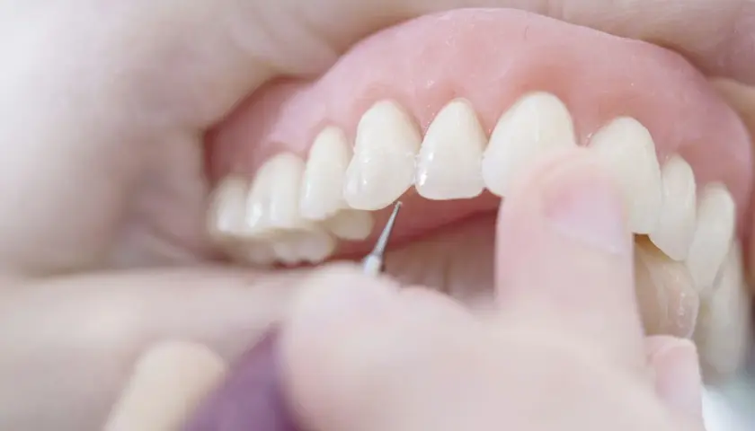 Dettaglio di una dentiera che viene posizionata, un passo importante per abituarsi alla dentiera e ritrovare un sorriso smagliante.