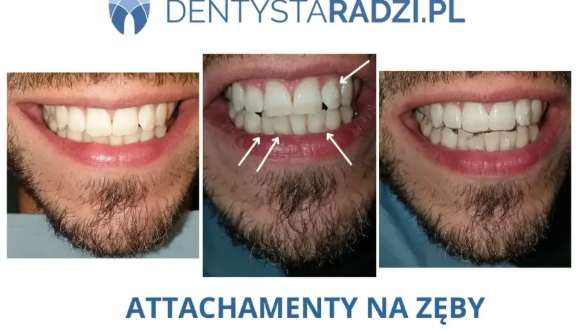 Przed i po: czy nakładki na zęby działają? Widoczne zbliżenie na uśmiech mężczyzny z widocznymi nierównościami, a następnie z nałożonymi przezroczystymi nakładkami.