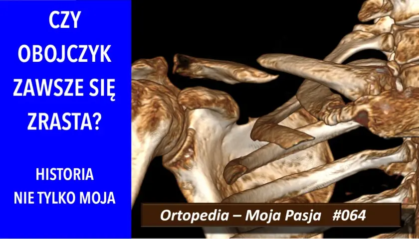 Trójwymiarowy obraz obojczyka, który pokazuje, ile zrasta się kość po urazie. "Ortopedia – Moja Pasja #064".