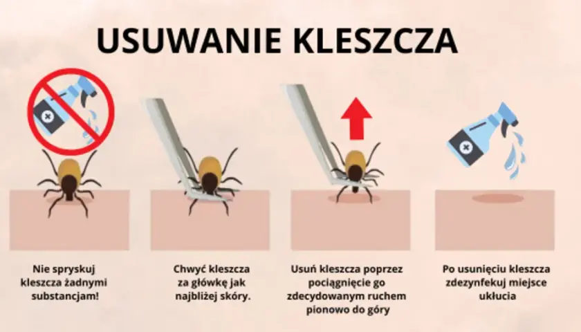 Nimfa kleszcza: jak usunąć bezpiecznie? Instrukcja krok po kroku
