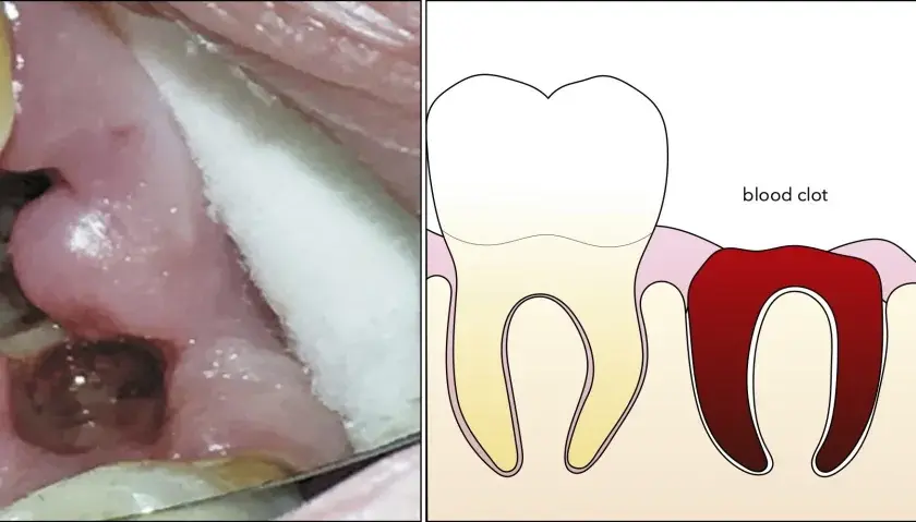 Comparación de un diente con coágulo sanguíneo y alveolitis seca, mostrando los síntomas de alveolitis seca.