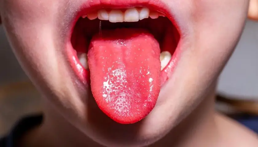 Bocca di bambino con lingua rossa e un po' bianca, possibile sintomo di streptococco.