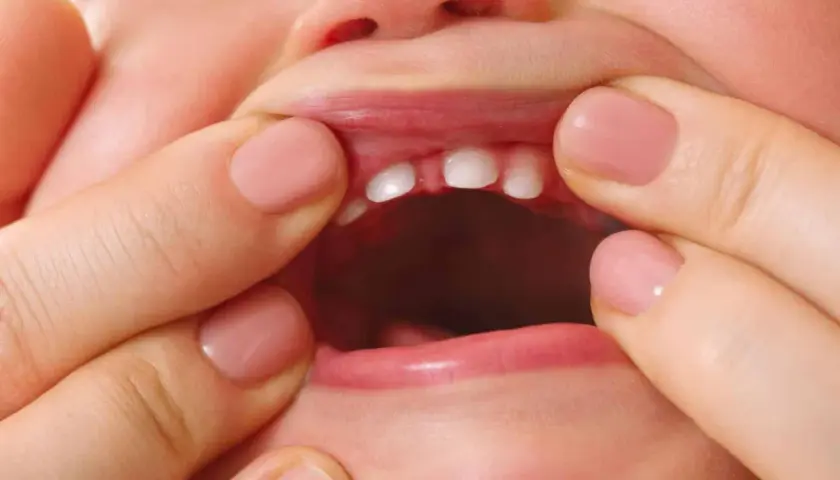 Bebé con frenillo labial inferior inflamado, mostrando sus pequeños dientes.