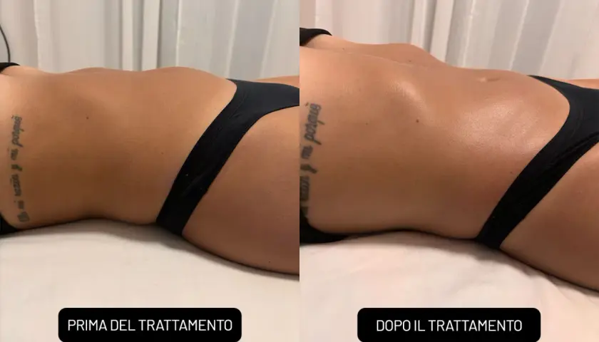 Confronto prima e dopo un massaggio rassodante: la pelle appare più tonica e liscia.
