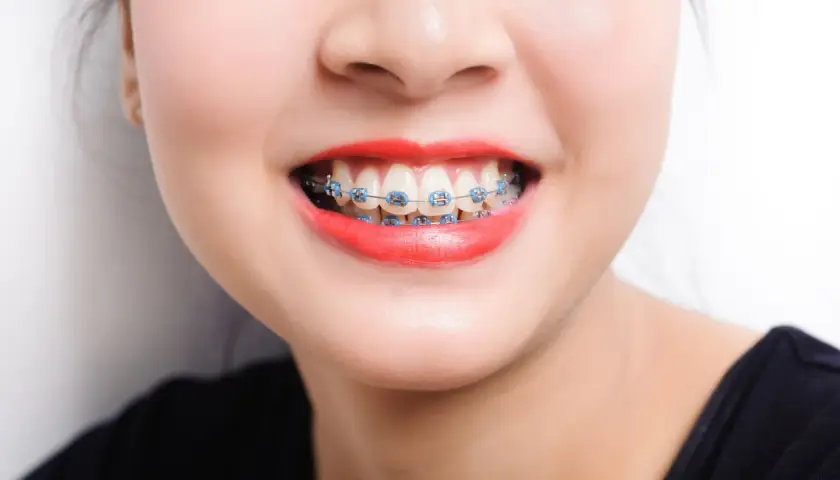 Sonrisa con brackets azules. A veces, los ataches me hacen heridas, pero la sonrisa vale la pena.