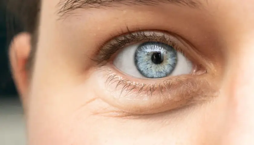 Ojo azul con ojeras hinchadas y finas arrugas bajo el párpado inferior.