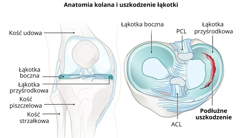 Anatomia kolana z widocznym podłużnym uszkodzeniem łąkotki przyśrodkowej.