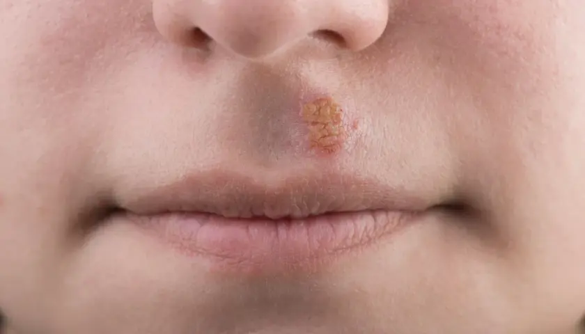 Herpes mento: lesione cutanea con crosticine giallastre e arrossate sul labbro superiore, vicino al naso.