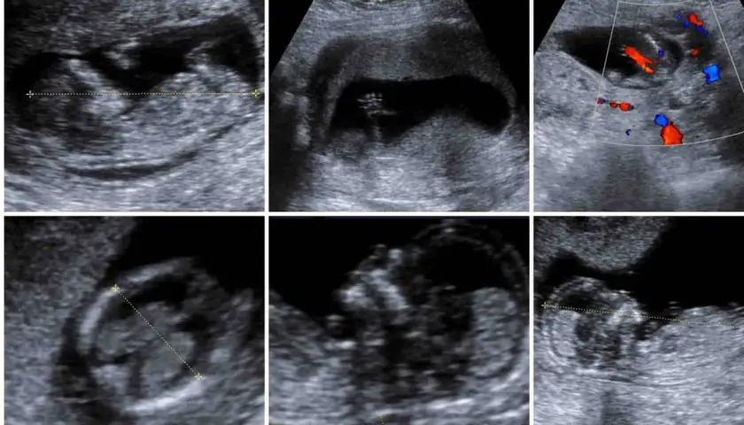 Ecografie fetali: immagini di un feto in utero, con misurazioni e flussi sanguigni. Si nota un movimento che potrebbe indicare un singhiozzo feto.