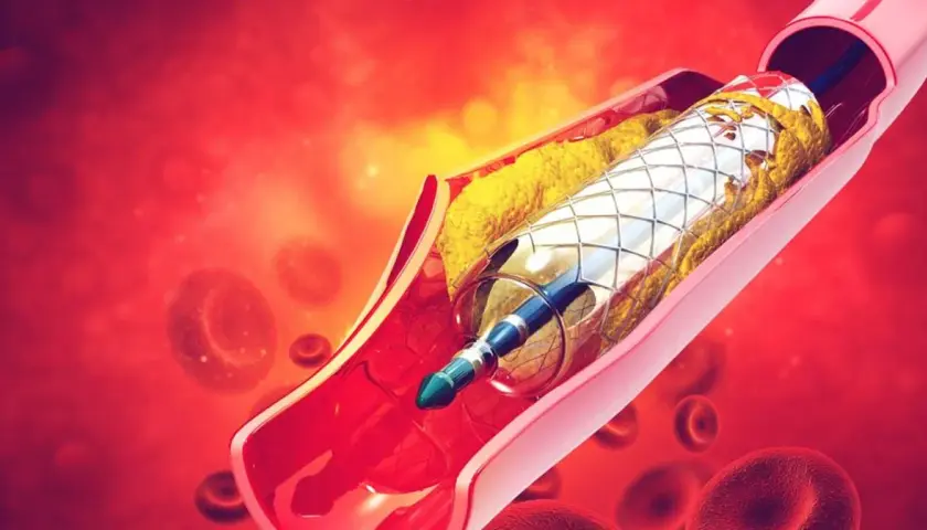 Stent w tętnicy z blaszką miażdżycową i krwinkami czerwonymi.