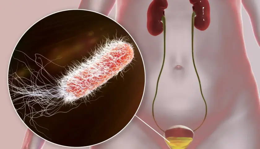 Gros plan sur un germe responsable d'une infection urinaire, montrant sa structure filamenteuse. Le système urinaire humain est également représenté.