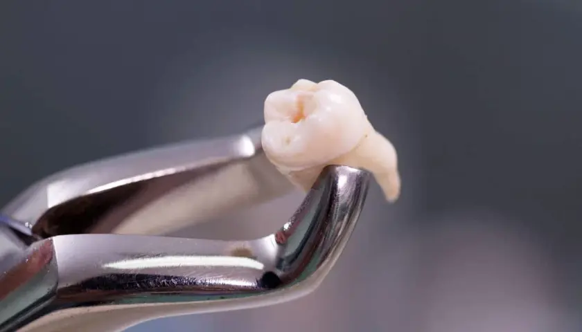 Pinzas dentales sujetan un diente extraído, resultado de una exodoncia dental.