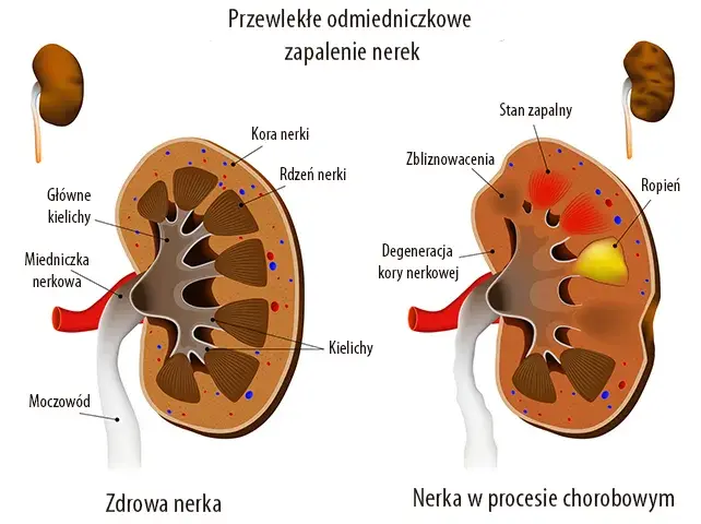 Choroba nerek: Co dzieje się z Twoim umysłem? Objawy i pomoc