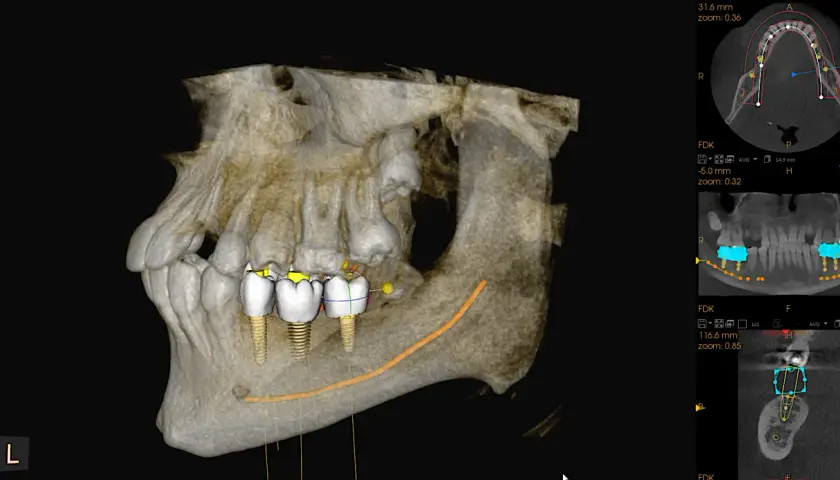 Trójwymiarowa tomografia stożkowa szczęki z widocznymi implantami zębowymi i planowaną ścieżką nerwu.