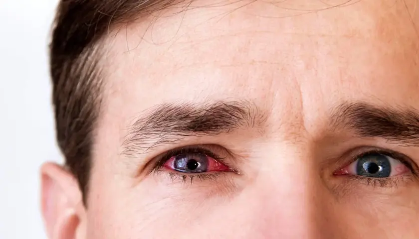 Gros plan sur les yeux d'un homme, l'un d'eux est rouge et irrité, présentant des symptômes de conjonctivite.
