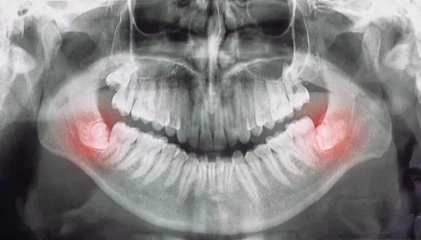 Gdzie z bólem zęba Chełm? Znajdź natychmiastową pomoc dentystyczną