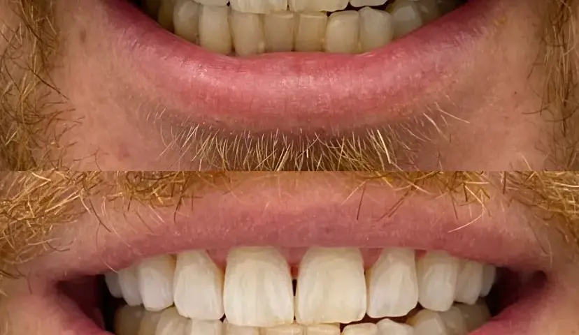 Wybielanie zębów u dentysty: efekty, koszty czy warto?