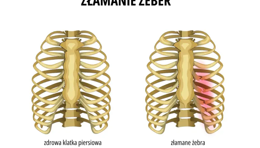 Porównanie zdrowej klatki piersiowej z tą, gdzie występuje złamanie żeber. Po prawej stronie widać uszkodzone żebra, zaznaczone na czerwono.