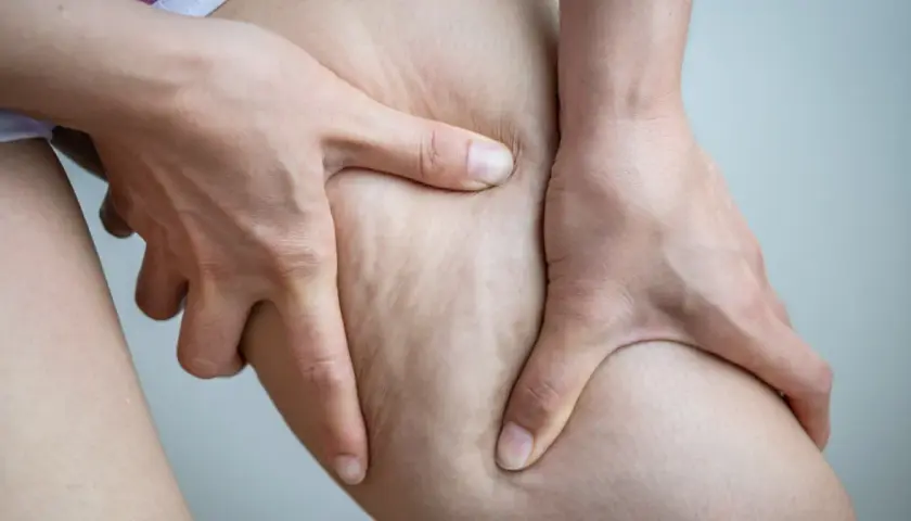 Jak pozbyć się cellulitu z ud? Domowe sposoby i zabiegi