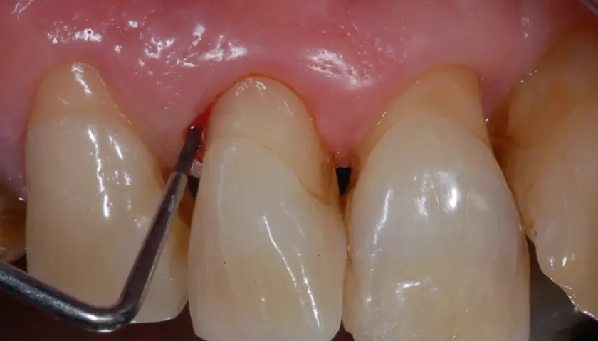 Strumento dentale che causa sanguinamento gengive vicino a un dente.