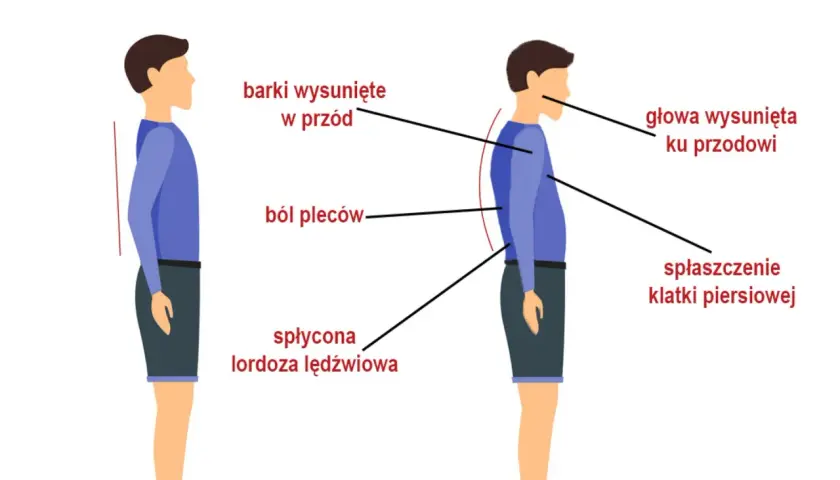 Ilustracja pokazuje prawidłową i nieprawidłową postawę. Nieprawidłowa postawa, z wysuniętymi barkami i głową, spłaszczoną klatką piersiową i płaską lordozą lędźwiową, może być objawem zesztywniającego zapalenia stawów kręgosłupa.