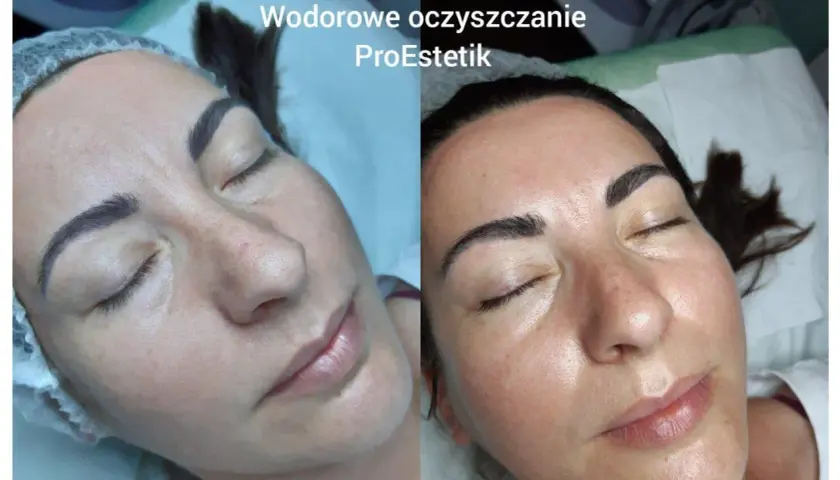 Przed i po zabiegu wodorowym na twarz. Skóra po oczyszczaniu jest promienna i nawilżona.