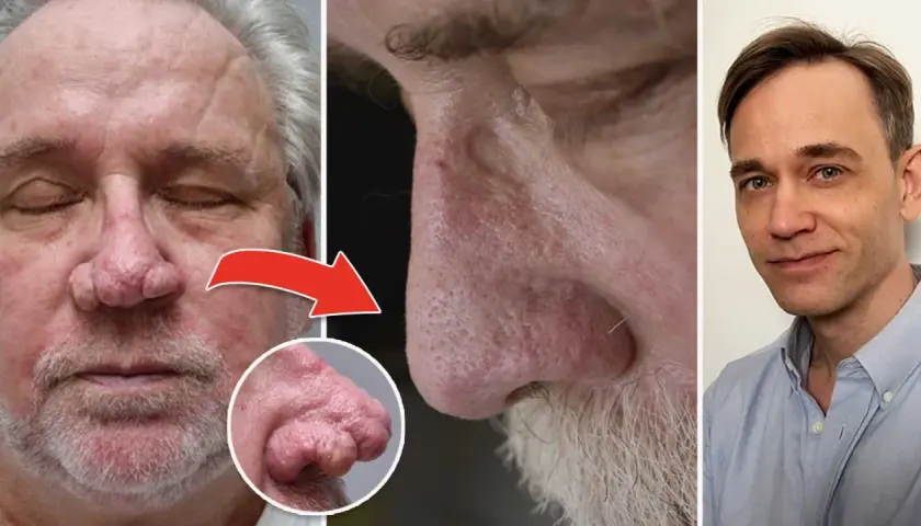 Före- och efterbilder som visar en mans näsa med rhinophyma och en läkare. Möjlig rhinophyma behandling.