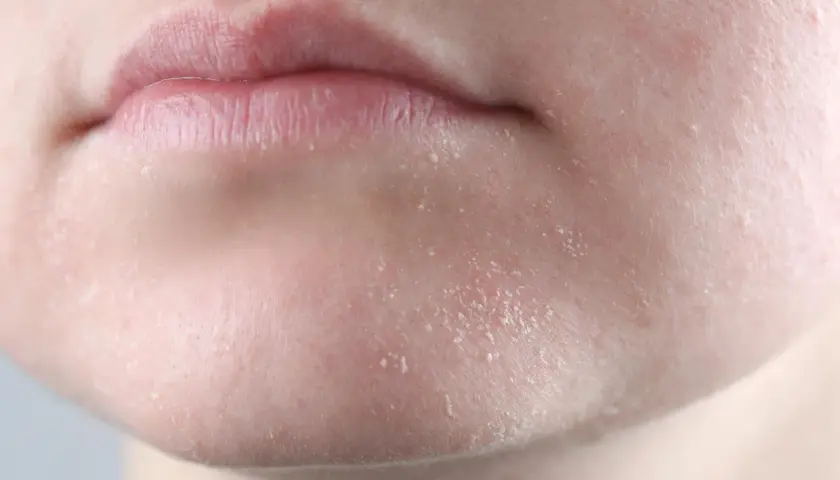 Gros plan sur des lèvres et un menton montrant une peau sèche et squameuse, signe potentiel d'une cause de peau sèche.