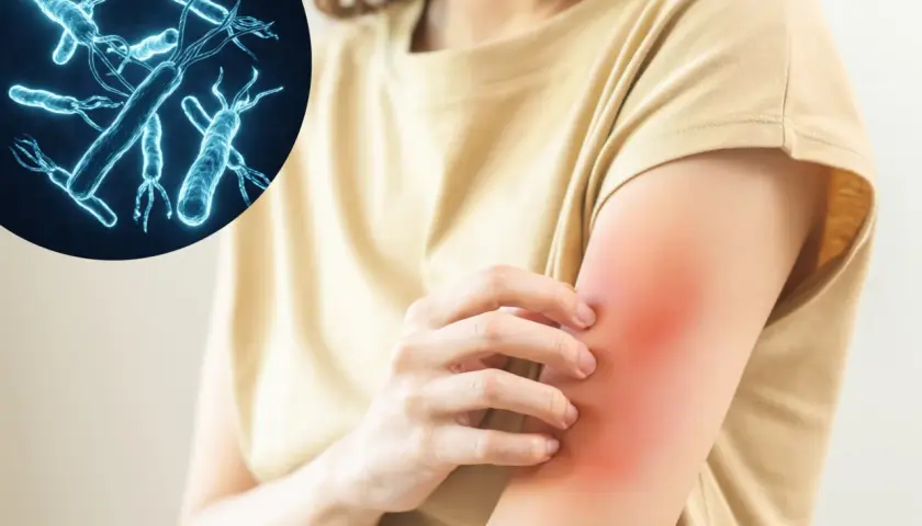 Bakterie Helicobacter pylori mogą wywoływać nie tylko problemy żołądkowe, ale także helicobacter pylori objawy skórne, takie jak zaczerwienienie i swędzenie ramienia.