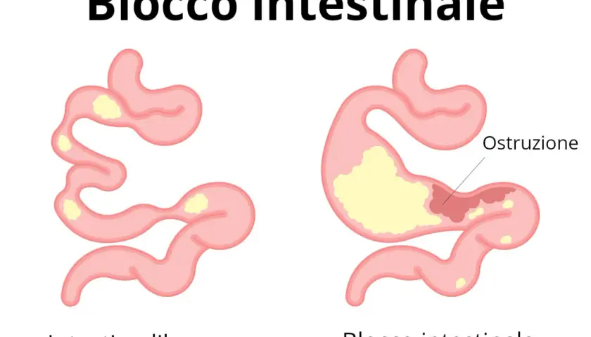 Illustrazione di un intestino libero e di un blocco intestinale, che spiega perché non riesco ad andare in bagno.