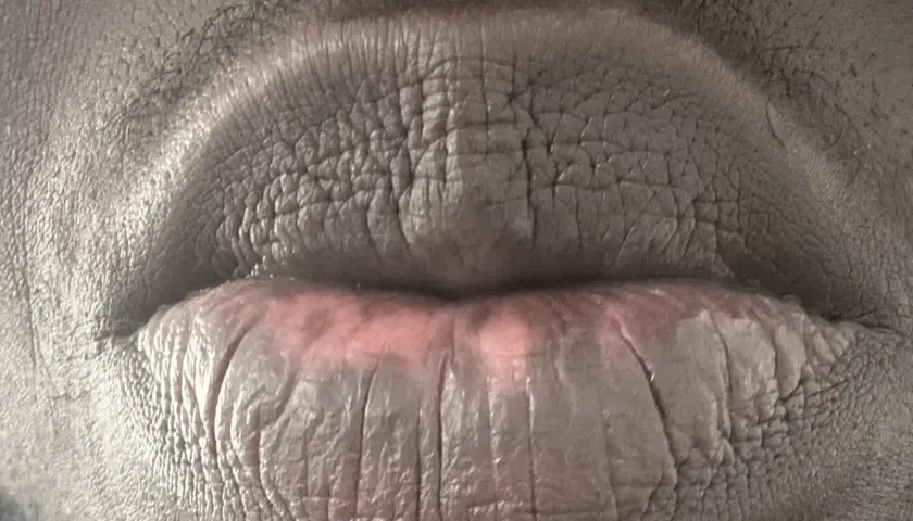 Labios agrietados y con manchas, evidencia de manchas en los labios por fumar.