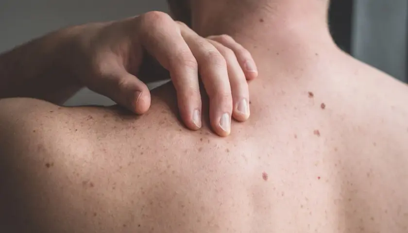 Mano che si gratta la schiena, con molti nei e lentiggini. Un fastidioso prurito schiena senza rossore.