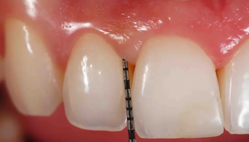 Sonda periodontal mide la profundidad de la encía. La piorrea se pega si no se cuida.