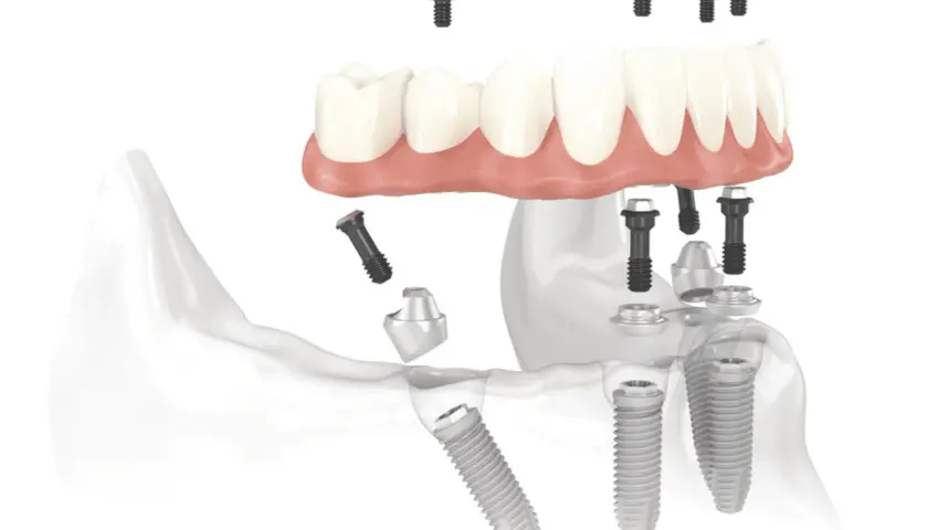 Impianti dentali e protesi, un ponte per un sorriso perfetto.
